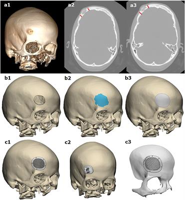 Case Report: Simultaneous Resection of Bone Tumor and CAD/CAM Titanium Cranioplasty in Fronto-Orbital Region